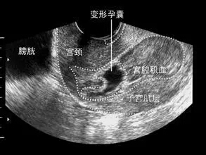 怀孕先兆流产是怎么回事