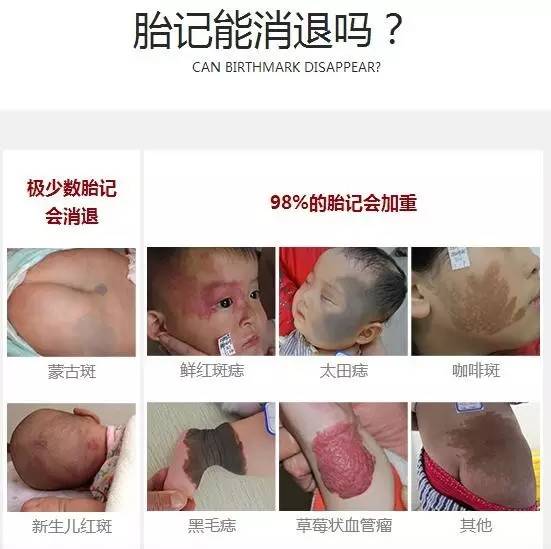 彻底去除胎记需要几个疗程？多长时间？