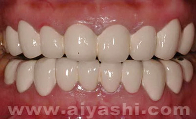 烤瓷牙做成这样,你有必要考虑换个医生了