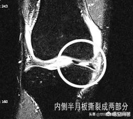 半月板撕裂微创手术后多久才能正常工作？听听医生怎么建议