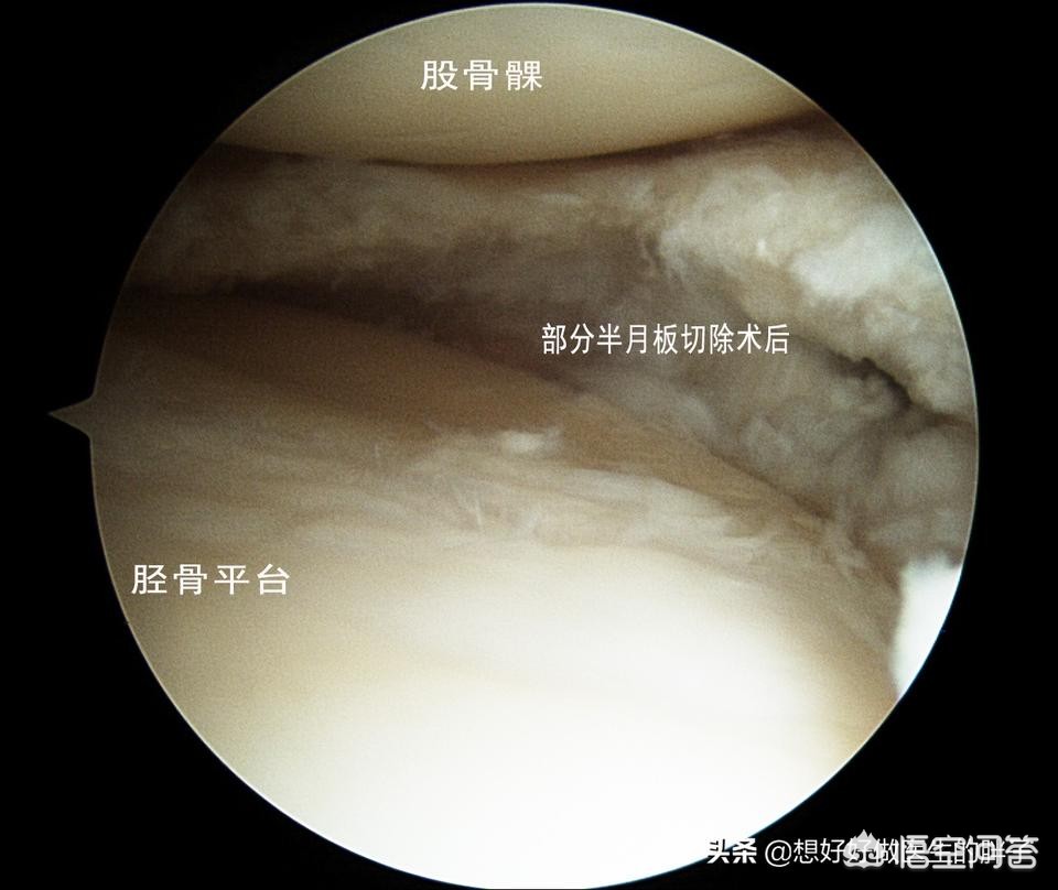 半月板撕裂微創手術後多久才能正常工作?聽聽醫生怎麼建議