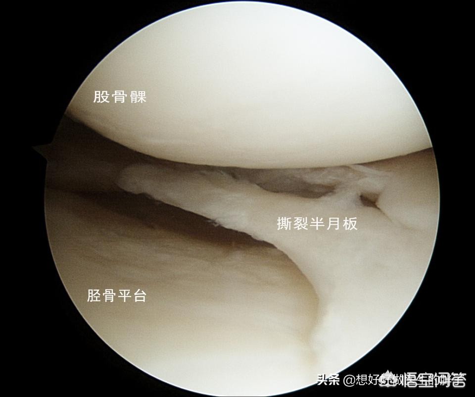 半月板撕裂微创手术后多久才能正常工作？听听医生怎么建议