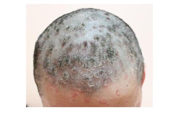 头皮癣症状早期图片