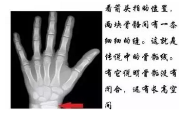 骨骺线闭合了还能长高吗？老天欠你多少厘米呢？