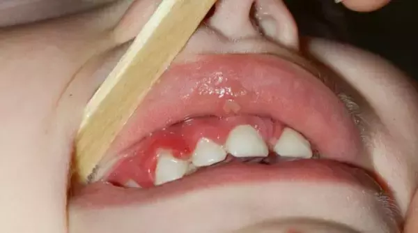夏季高发疱疹性咽颊炎,宝宝出现这些症状可要当心啦!