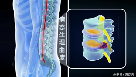 腰椎间盘突出如何治？方法透析！