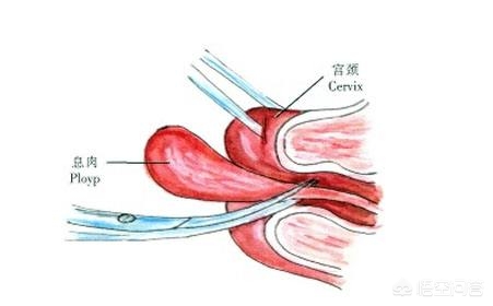 什么是子宫息肉，是什么原因引起的