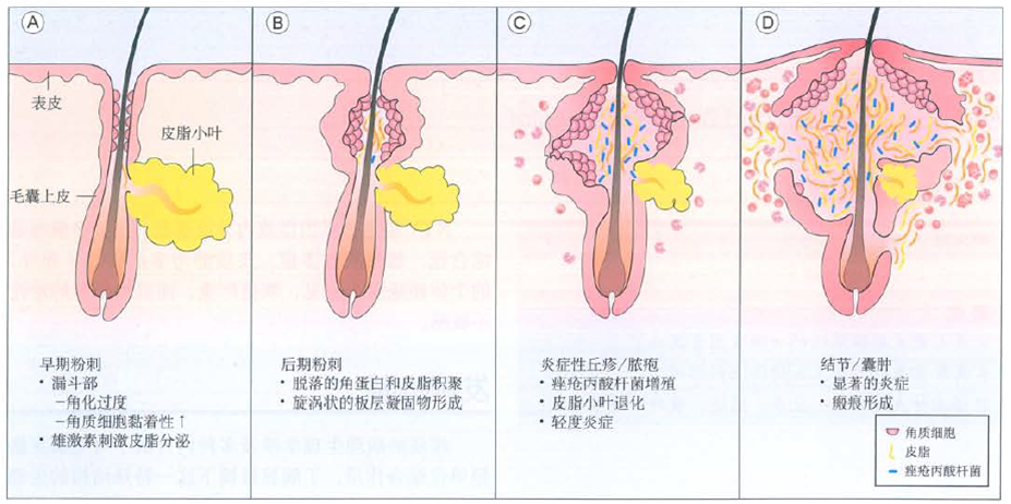 好不容易祛掉了烦人的痘痘，那明显的痘印该怎么祛？