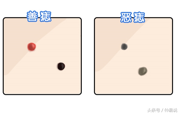 恶痣和善痣的区别图片(身上这里长痣) - 赤虎壹号