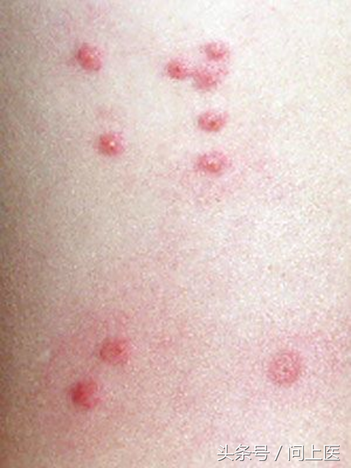 圖解12種常見蚊蟲叮咬的皮膚痕跡，畫面太嚇人不敢看！