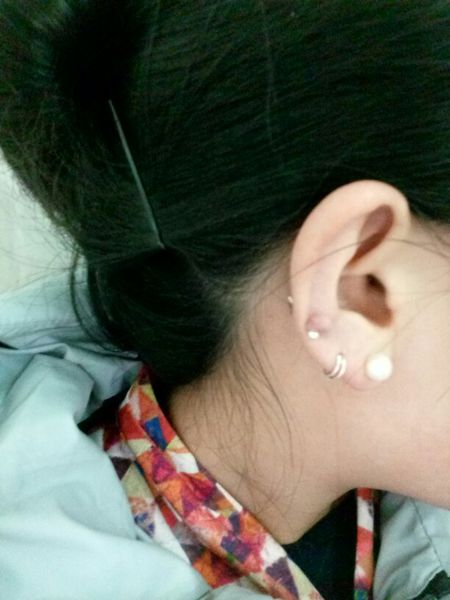 夏季扎了耳洞发炎、化脓怎么办？