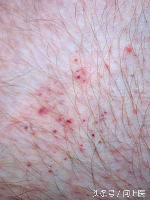 圖解12種常見蚊蟲叮咬的皮膚痕跡，畫面太嚇人不敢看！