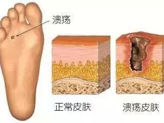新鞋磨脚还傻傻贴创可贴?教你5招,立马舒适穿新鞋
