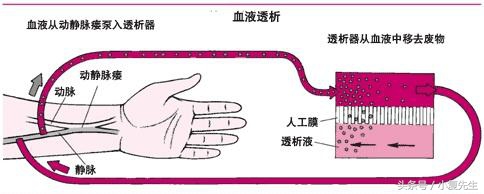 尿毒症透析患者“生命线”血透通路动静脉内瘘保护指导建议