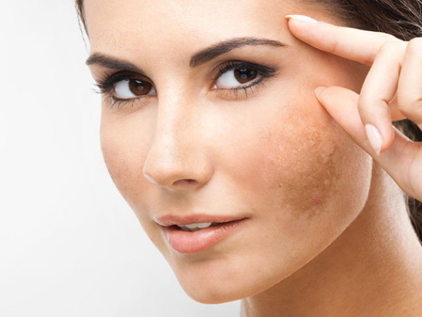 chloasma),在我国又被称之为:肝斑,褐斑,蝴蝶斑,荷尔蒙斑,孕斑,妊娠