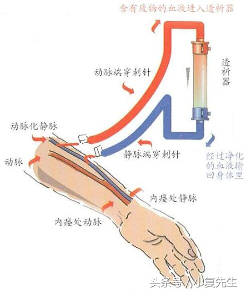 尿毒症透析患者“生命线”血透通路动静脉内瘘保护指导建议