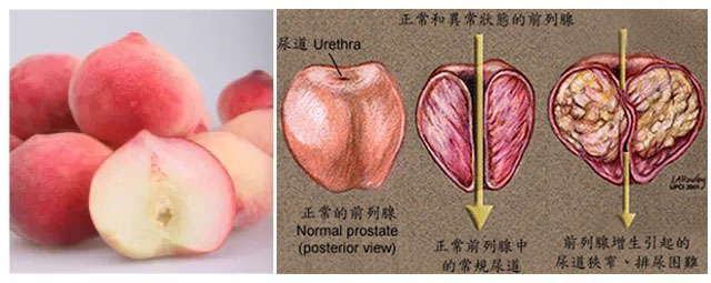 科普：舌尖上的泌尿外科
