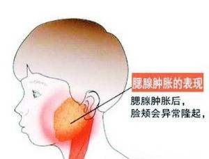 30岁男子体内无精不育！罪魁祸首竟是16年前的“腮腺炎”？