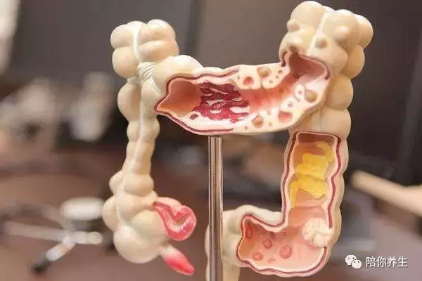 直肠癌05大便时出现脓血便或出血混有黏液,通常还会出现腹痛,便频