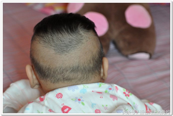 婴儿后脑勺头发少了一圈,是怎么回事?枕秃需要补钙促生长吗?