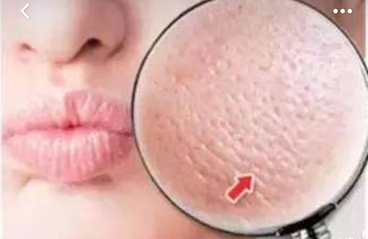 毛孔粗大怎么办？