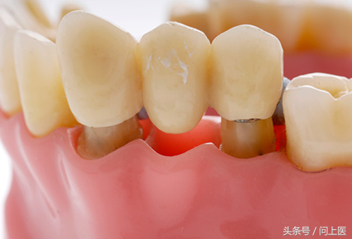 牙桥、牙冠、牙托、牙贴……这些牙科用具你见过几个？