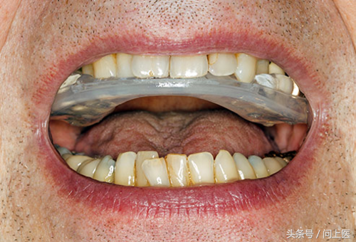 牙桥、牙冠、牙托、牙贴……这些牙科用具你见过几个？