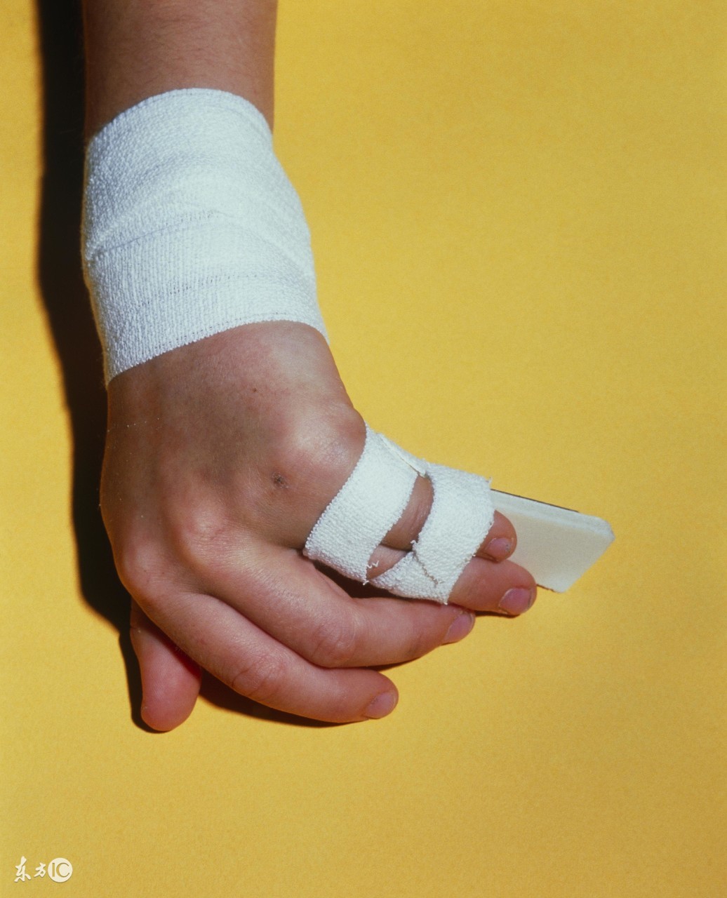 孩子小拇指骨折后手指变短了能恢复吗手指骨折好了之后手指变短了