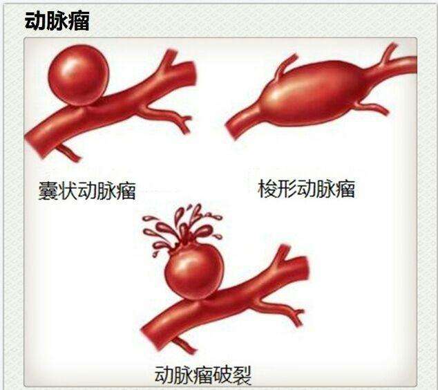 脑动脉瘤是肿瘤吗？万一出血死亡率近1/3，你却对它一无所知！