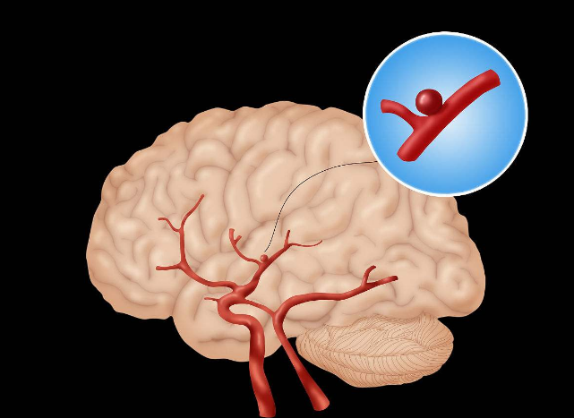 脑动脉瘤是肿瘤吗？万一出血死亡率近1/3，你却对它一无所知！