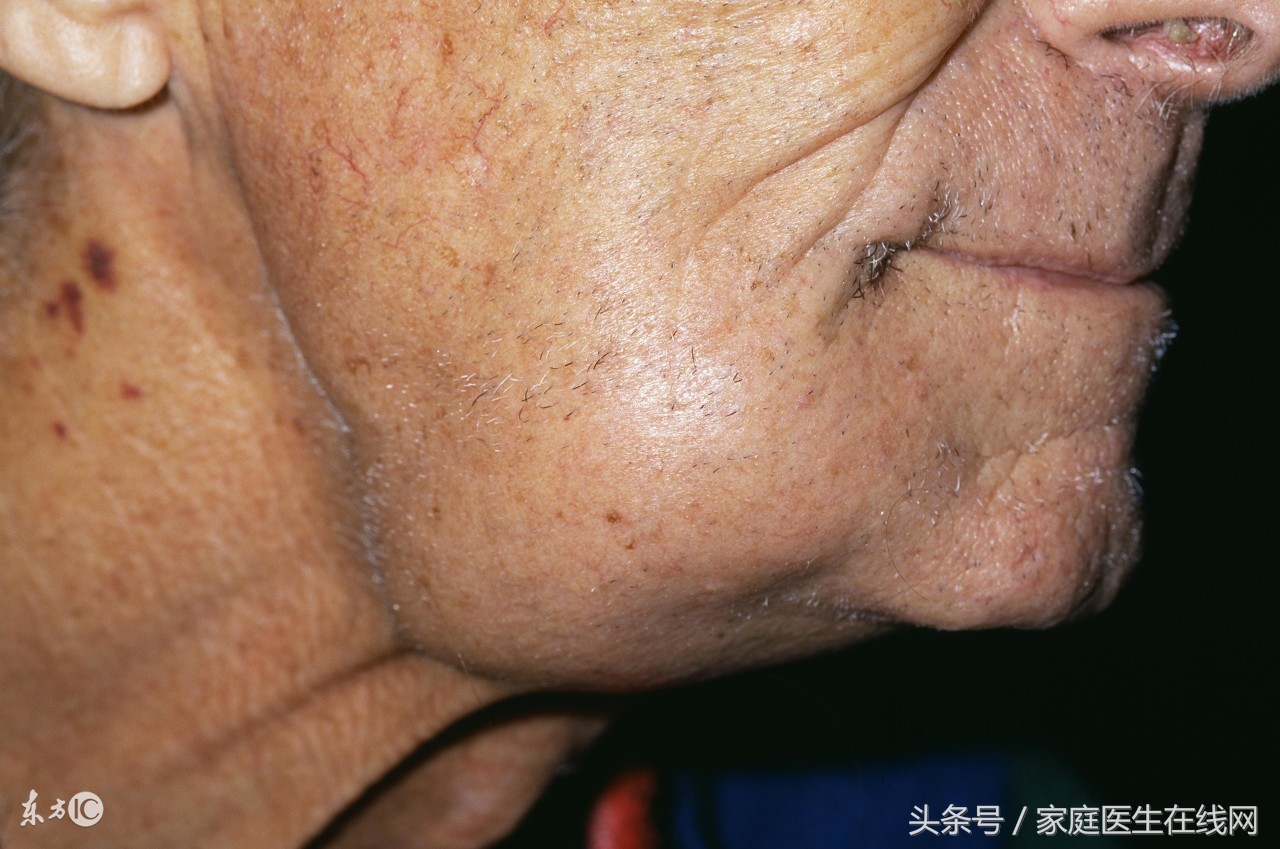 淋巴癌患者最终死亡原因分析