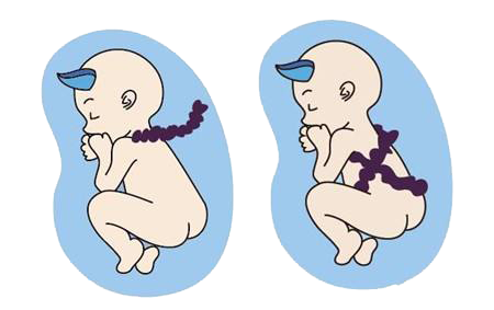 孕期警惕三种脐带异状，保护胎儿生命线！