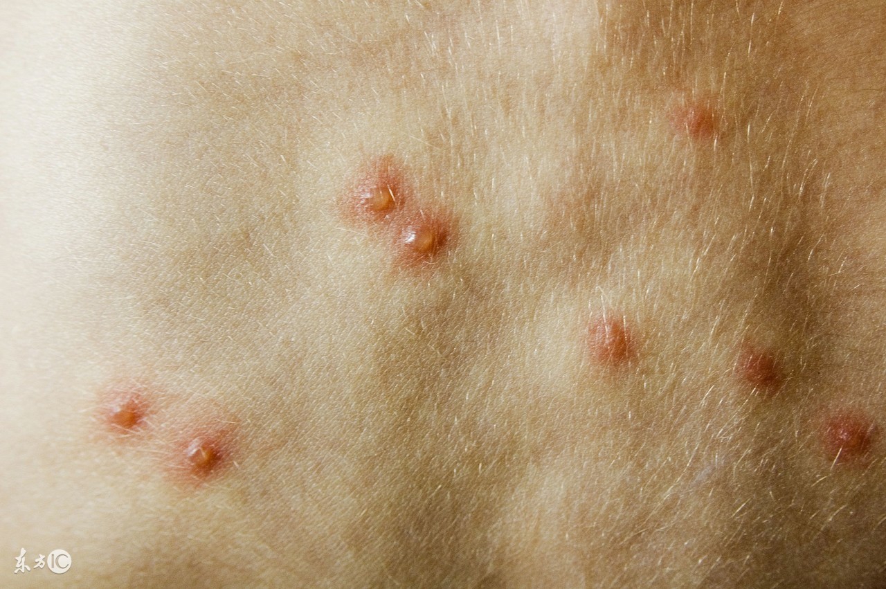 水痘皮疹开始多出现在躯干部,然后波及到面部和四肢.