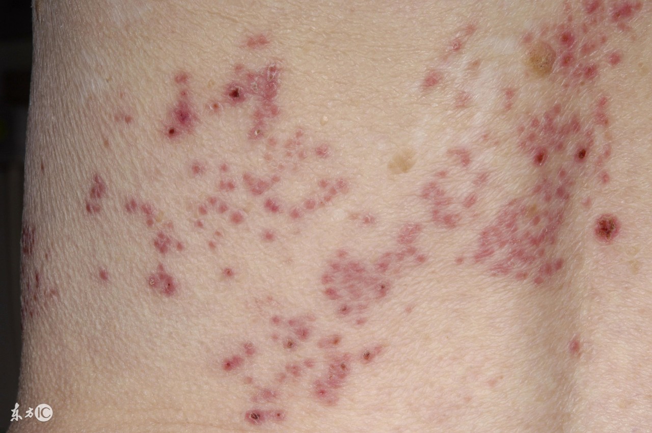 爸爸妈妈知识:水痘的症状,治疗,护理