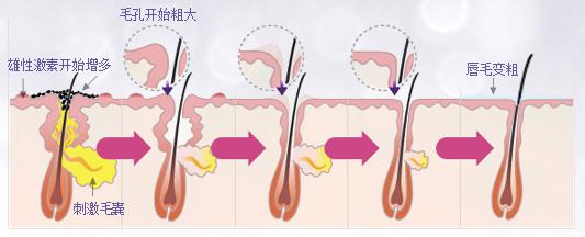 如何去除唇毛？拔、刮、甚至激光它们都管用吗？