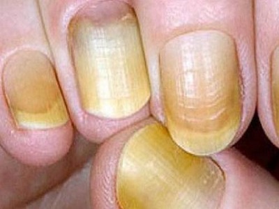 抽烟人的手指右手食指与中指的第一指节会有烟熏黄,两年以上烟龄较为