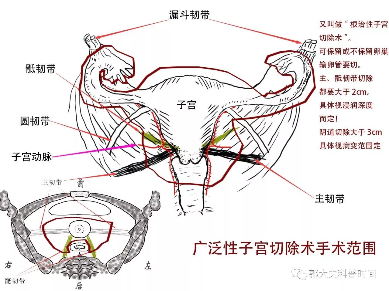 剖宫产手术图解图片