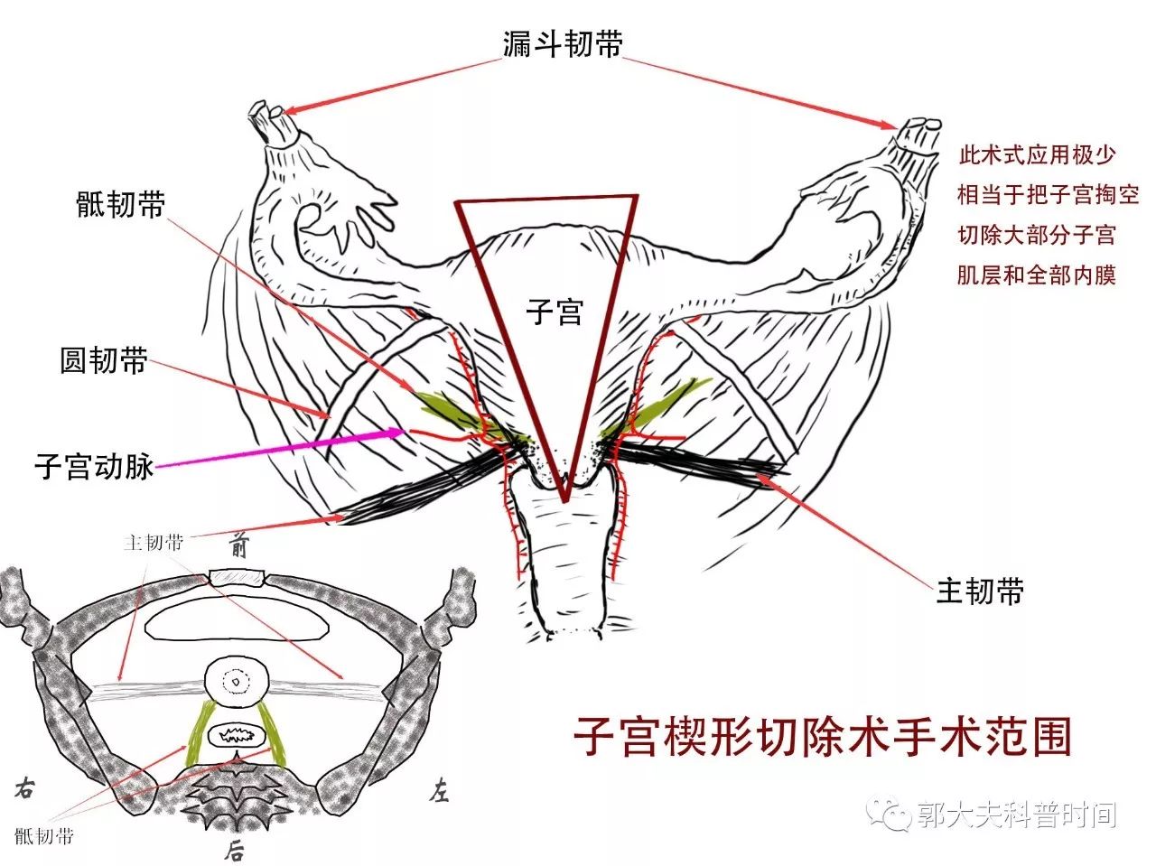 自宫是切除哪里(关于子宫切除的小秘密（一）——切除范围)