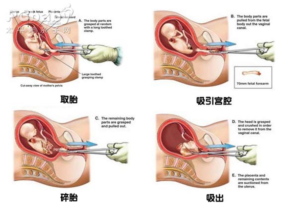 怀孕多久可以做人流