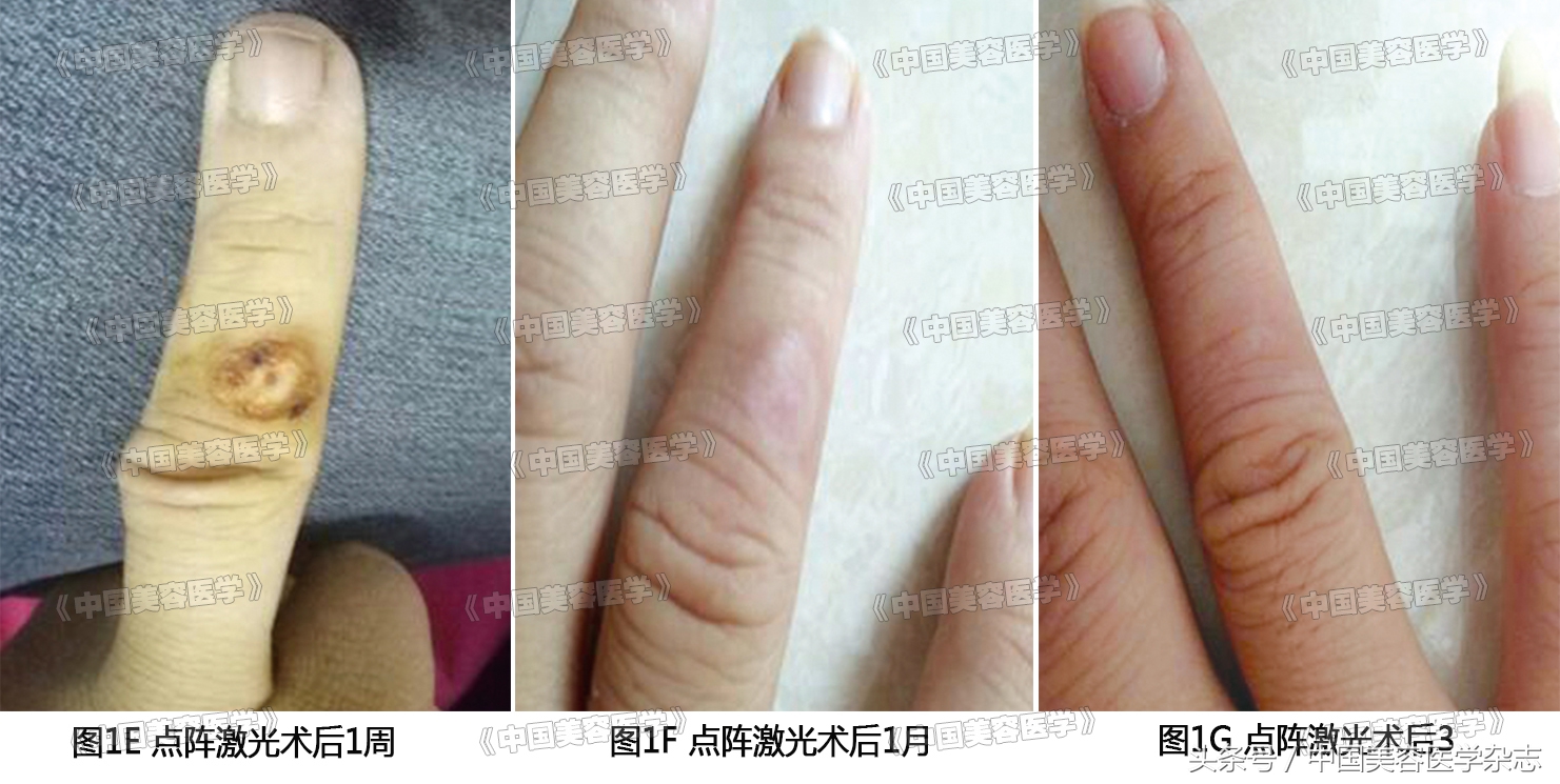 烦人的肉芽肿,怎么处理?快看二氧化碳点阵激光的神奇威力