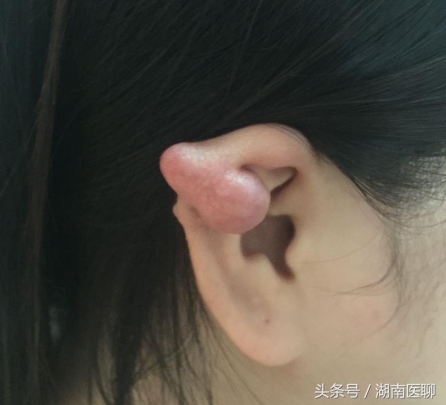 年轻女子打耳洞，耳上长米粒疙瘩，后来成了鹌鹑蛋大肿块！