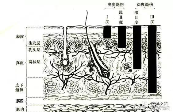 记住这个口诀，让你秒杀烧伤面积计算！（附例题）