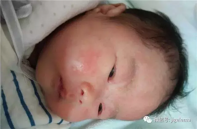 湿疹、腹泻可能是孩子牛奶过敏，专家教你该如何判断和预防！