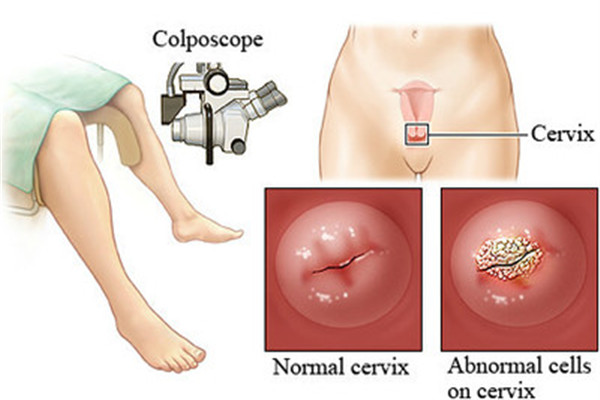 春玲医生健康说：宫颈LEEP锥切