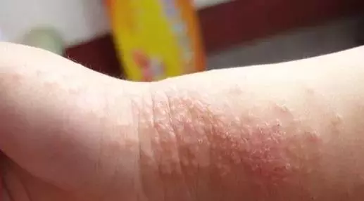 孩子湿疹不复发(孩子湿疹不复发怎么办)