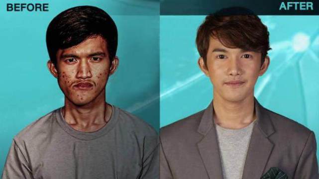 22岁小伙赴韩整容10余次，从丑男变成帅小伙，被美女倒追