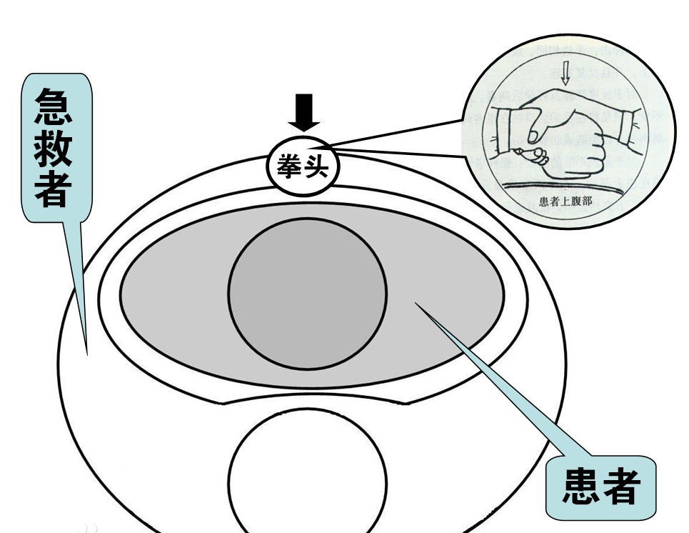 什么是海姆立克急救法？附：海姆立克急救法的详细步骤-第3张图片