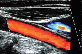 评估全身动脉硬化的简便方法：颈动脉超声