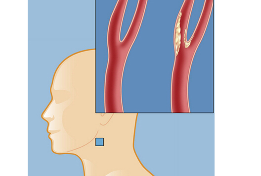 评估全身动脉硬化的简便方法：颈动脉超声