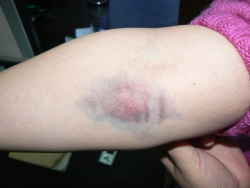 淤血图片(抽完血手臂青肿一片什么原因) - 赤虎壹号